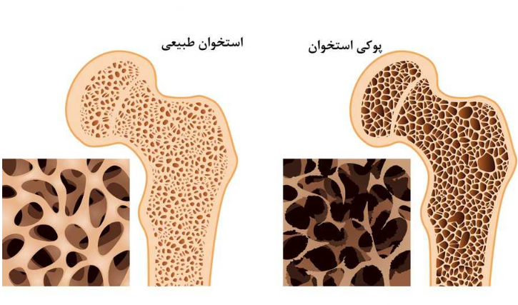 چگونه از  پوکی استخوان جلوگیری کنیم؟ چگونه از  پوکی استخوان جلوگیری کنیم؟